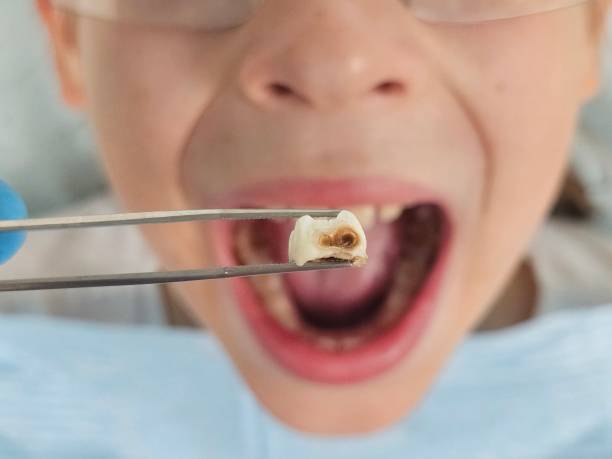 Best Emergency Treatment for Toothache in Bertville, AL